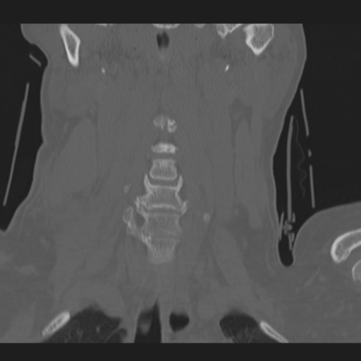 C2 fracture (Radiopaedia 34091-35341 Coronal bone window 14).png