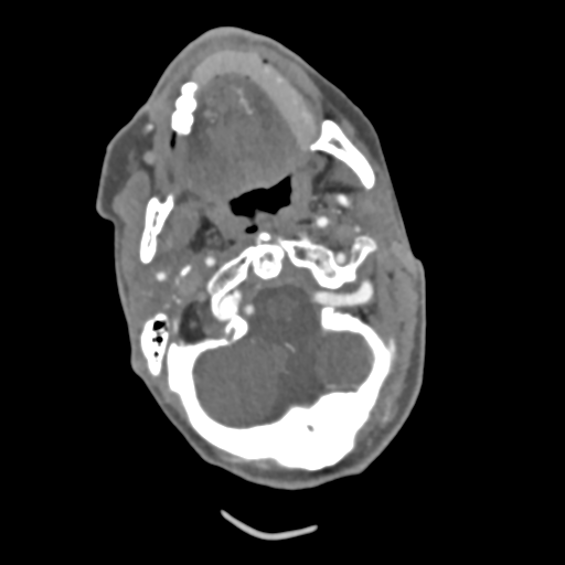 File:C2 fracture with vertebral artery dissection (Radiopaedia 37378-39200 A 179).png