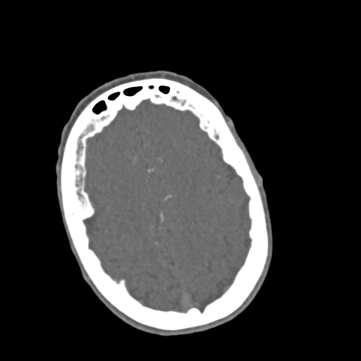 File:C2 fracture with vertebral artery dissection (Radiopaedia 37378-39200 A 281).png