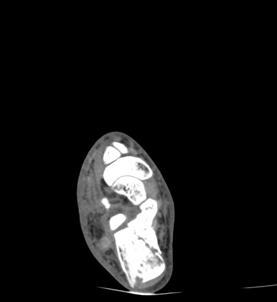 Calcaneal fracture - Sanders type 3ac (Radiopaedia 82491-96862 C 69).jpg