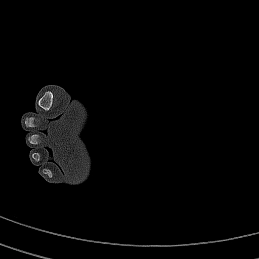 Calcaneal fracture - Sanders type 4 (Radiopaedia 90179-107370 Axial bone window 67).jpg