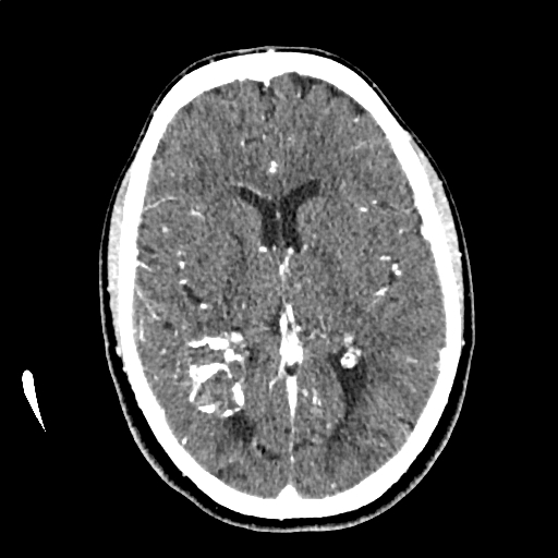Calcified cerebral hydatid cyst (Radiopaedia 65603-74717 Axial with contrast 40).jpg