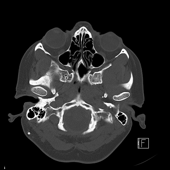 Calcified chronic subdural hematoma (Radiopaedia 77374-89492 Axial bone window 14).jpg