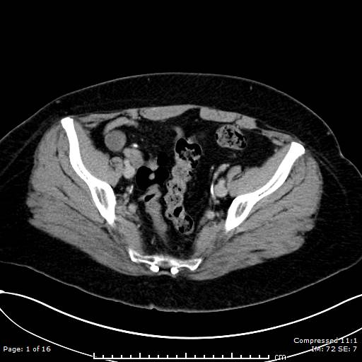 File:Calcified uterine fibroid (Radiopaedia 56077-62759 Axial C+ delayed 1).jpg