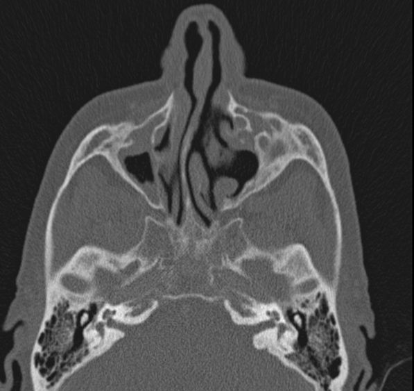 Caldwell-Luc operation (Radiopaedia 52329-58225 Axial bone window 33).jpg