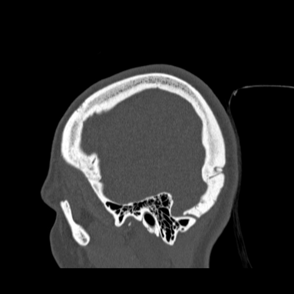 Calvarial osteoma (Radiopaedia 36520-38079 Sagittal bone window 19).jpg