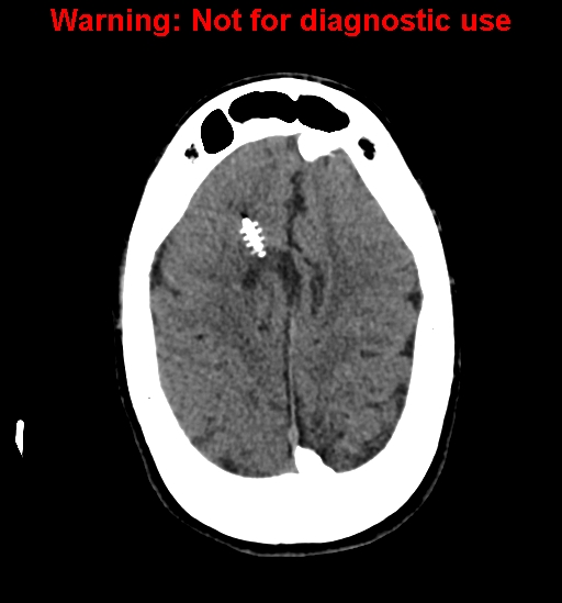 File:Calvarial thickening from chronic shunting (Radiopaedia 60079-67637 Axial non-contrast 23).jpg
