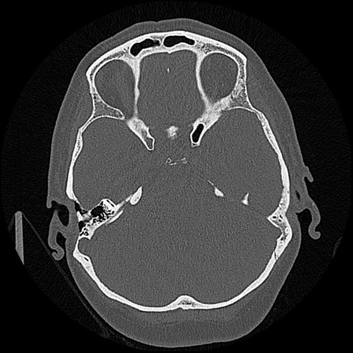 Canal up mastoidectomy (Radiopaedia 78108-90638 Axial bone window 106).jpg