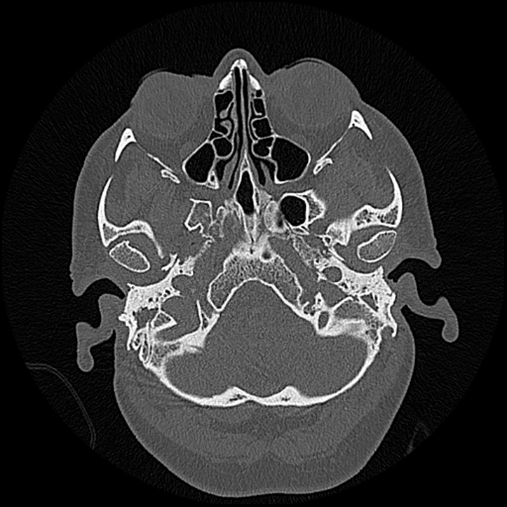 Canal up mastoidectomy (Radiopaedia 78108-90638 Axial bone window 34).jpg