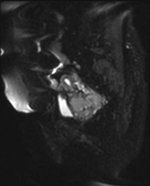 Cancer cervix - stage IIb (Radiopaedia 75411-86615 Sagittal DWI 7).jpg