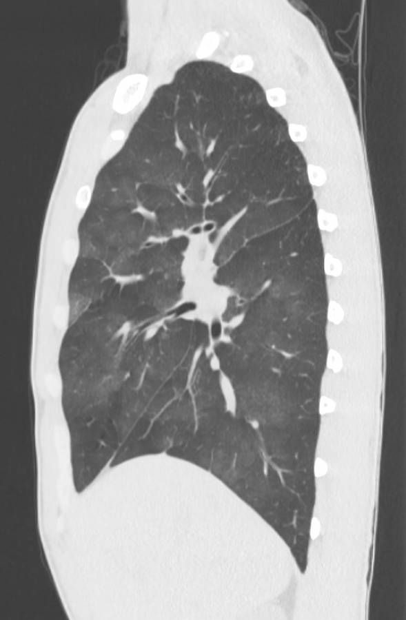 Cannabis-induced diffuse alveolar hemorrhage (Radiopaedia 89834-106946 Sagittal lung window 46).jpg