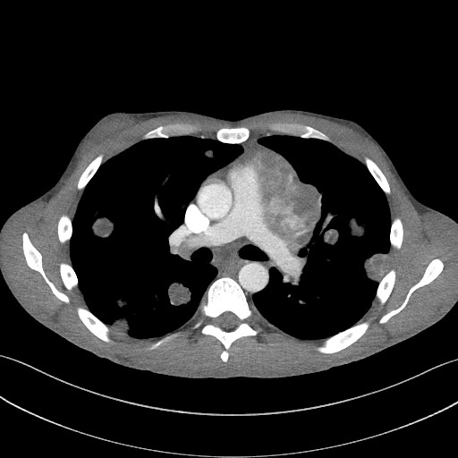 File:Cannonball metastases - testicular choriocarcinoma (Radiopaedia 84510-99891 B 55).jpg