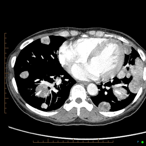 File:Canonball lung metastasis (Radiopaedia 77634-89837 B 68).jpg