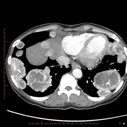 Canonball lung metastasis (Radiopaedia 77634-89837 B 79).jpg