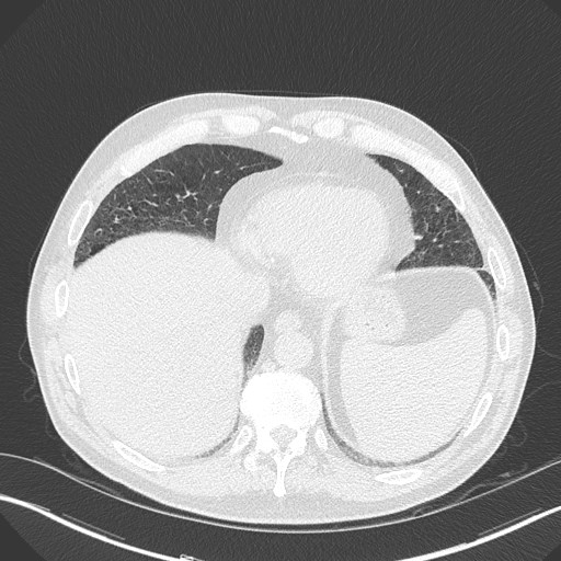 Caplan syndrome (Radiopaedia 56667-63530 Axial lung window 154).jpg