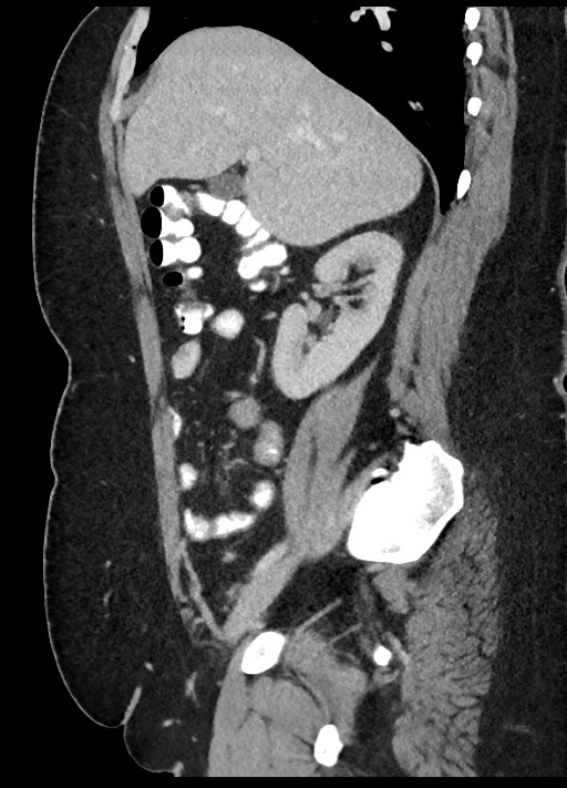 Carcinoid tumor - terminal ileum (Radiopaedia 60931-68739 C 68).jpg