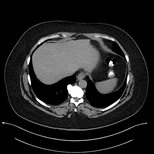 File:Carcinoid tumor - terminal ileum (Radiopaedia 60931-68740 Axial non-contrast 6).jpg