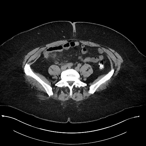 Carcinoid tumor - terminal ileum (Radiopaedia 60931-68740 Axial non-contrast 79).jpg