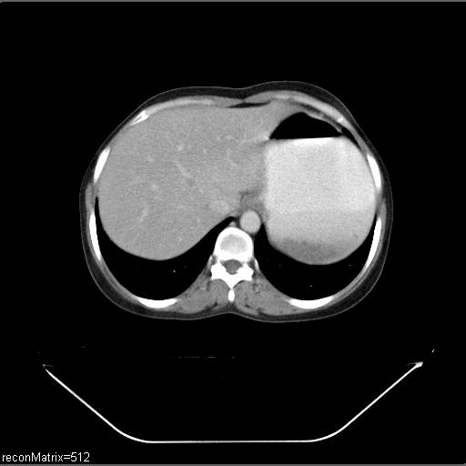 File:Carcinoma of esophagus (Radiopaedia 27356-27550 A 7).jpg
