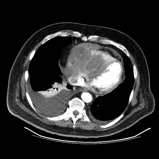 File:Cardiac lymphoma (Radiopaedia 38690-40836 Axial C+ CTPA 15).jpg