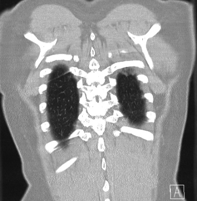 Cardiac sarcoidosis (Radiopaedia 74548-85534 Coronal lung window 63).jpg
