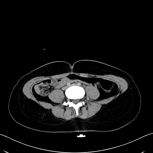 Caroli disease with medullary sponge kidney (Radiopaedia 82622-96804 C 47).jpg