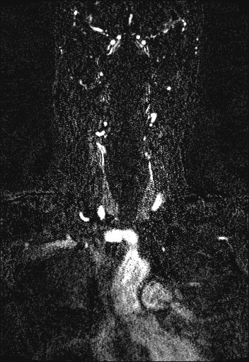 Carotid artery dissection (Radiopaedia 28441-28689 Coronal MRA 26).jpg