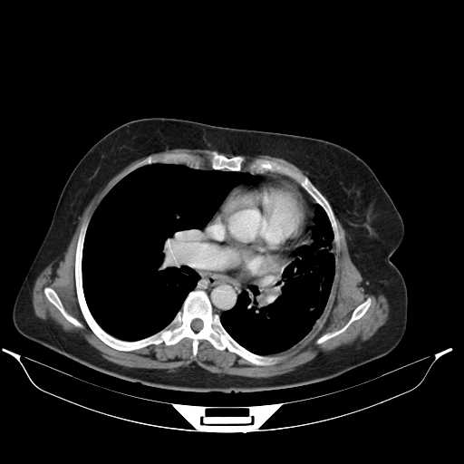 File:Carotid body tumor (Radiopaedia 21021-20948 A 38).jpg