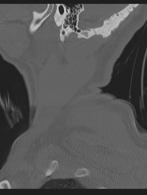 Cavernoma of cervical cord (Radiopaedia 50838-56346 Sagittal bone window 4).png