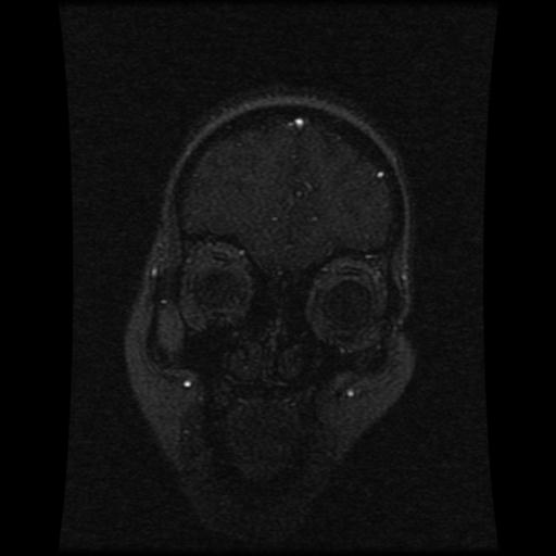 File:Cavernoma with developmental venous anomaly (Radiopaedia 22470-22507 MRV 107).jpg