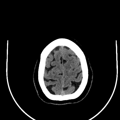 Cavernous hemangioma of the cerebellar falx (Radiopaedia 73025-83723 Axial non-contrast 120).jpg