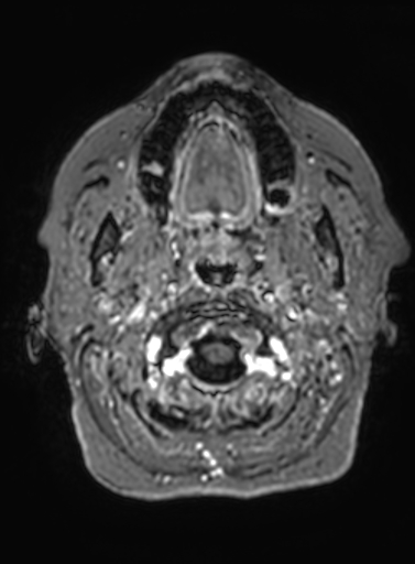 Cavernous hemangioma of the cerebellar falx (Radiopaedia 73025-83724 Axial T1 C+ 333).jpg