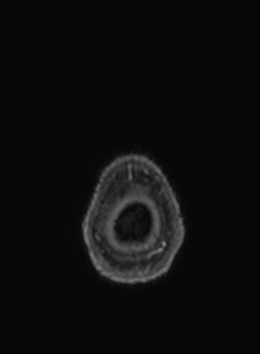 Cavernous hemangioma of the cerebellar falx (Radiopaedia 73025-83724 Axial T1 C+ 4).jpg