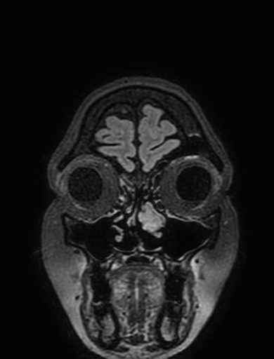 Cavernous hemangioma of the cerebellar falx (Radiopaedia 73025-83724 Coronal FLAIR 25).jpg