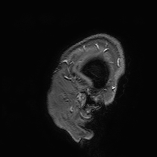 Cavernous hemangioma of the cerebellar falx (Radiopaedia 73025-83724 Sagittal T1 C+ 6).jpg