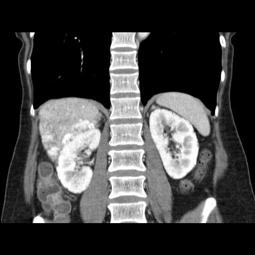 Cavernous hepatic hemangioma (Radiopaedia 75441-86667 C 98).jpg
