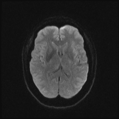 Cavernous sinus meningioma (Radiopaedia 63682-72367 DWI 33).jpg
