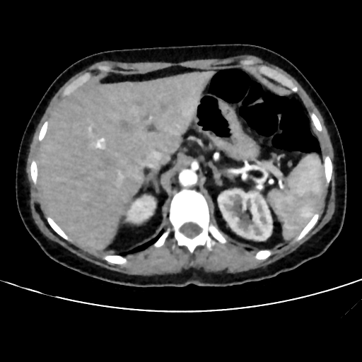 File:Cavitating lung mass - squamous cell carcinoma (Radiopaedia 48047-52854 B 44).png