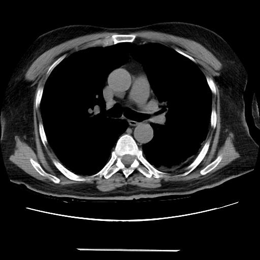 File:Cavitating pulmonary metastases (Radiopaedia 89545-106544 Axial non-contrast 24).jpg