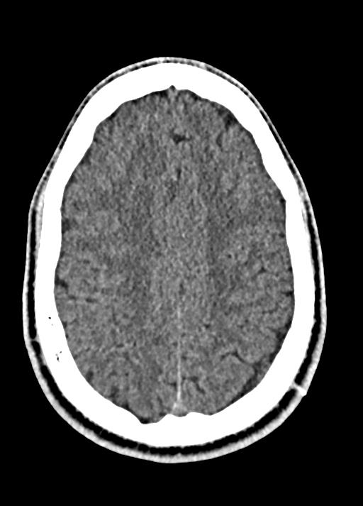 Cavum septum pellucidum and cavum vergae (Radiopaedia 77797-90060 Axial Brain Window 78).jpg