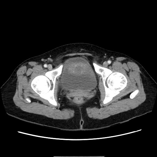 Cecal adenocarcinoma (Radiopaedia 75909-87331 A 84).jpg