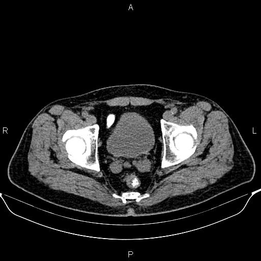 Cecal adenocarcinoma (Radiopaedia 85324-100916 Axial non-contrast 92).jpg