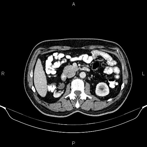Cecal adenocarcinoma (Radiopaedia 85324-100916 B 39).jpg