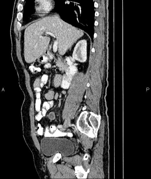 File:Cecal cancer with appendiceal mucocele (Radiopaedia 91080-108651 E 37).jpg