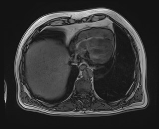 Cecal mass causing appendicitis (Radiopaedia 59207-66532 D 21).jpg