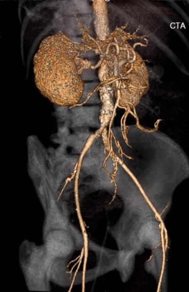 File:Celiac artery severe stenosis and dissection (Radiopaedia 44128-47842 C+ arterial phase 4).jpg