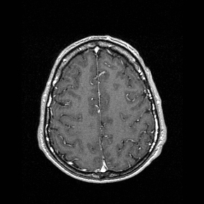 Central-variant posterior reversible encephalopathy syndrome (PRES) (Radiopaedia 43880-47358 Axial T1 C+ 131).jpg