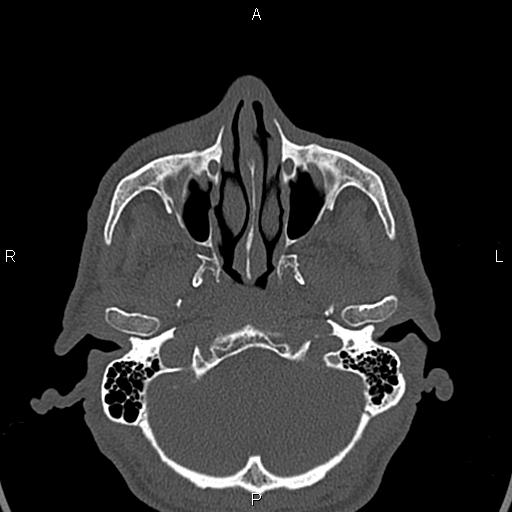File:Central giant cell granuloma (Radiopaedia 83346-97761 Axial bone window 42).jpg