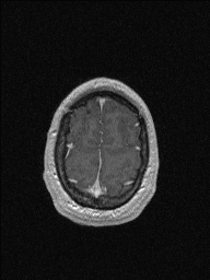 Central neurocytoma (Radiopaedia 56690-63469 Axial T1 C+ 147).jpg