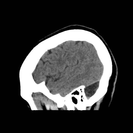 File:Central neurocytoma (Radiopaedia 65317-74346 C 12).png